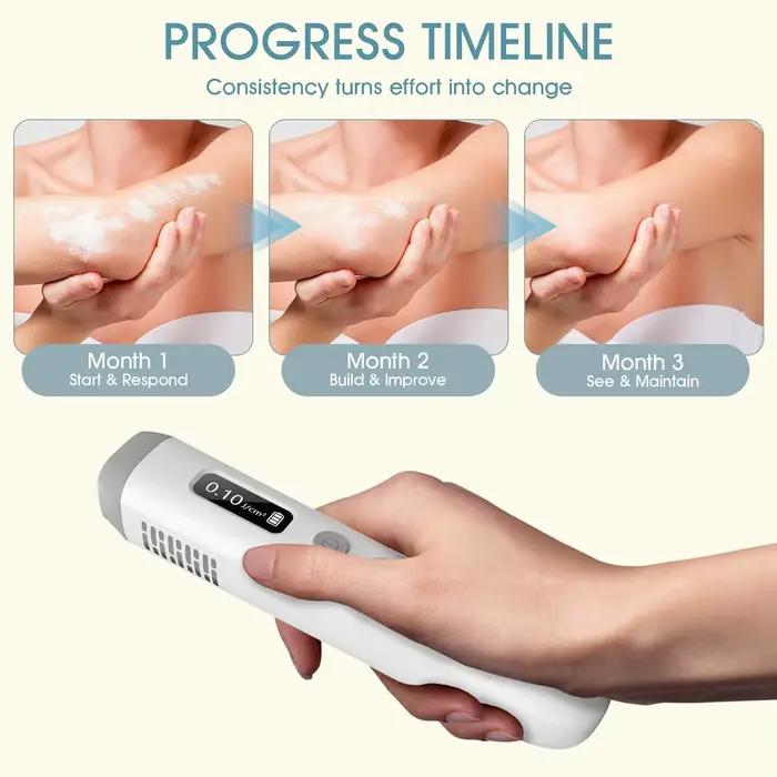 Lampe de photothérapie UVB 308 nm pour le vitiligo, appareil de thérapie par lumière UV portable pour usage domestique, traitement du psoriasis, de l'eczéma et des taches blanches cutanées