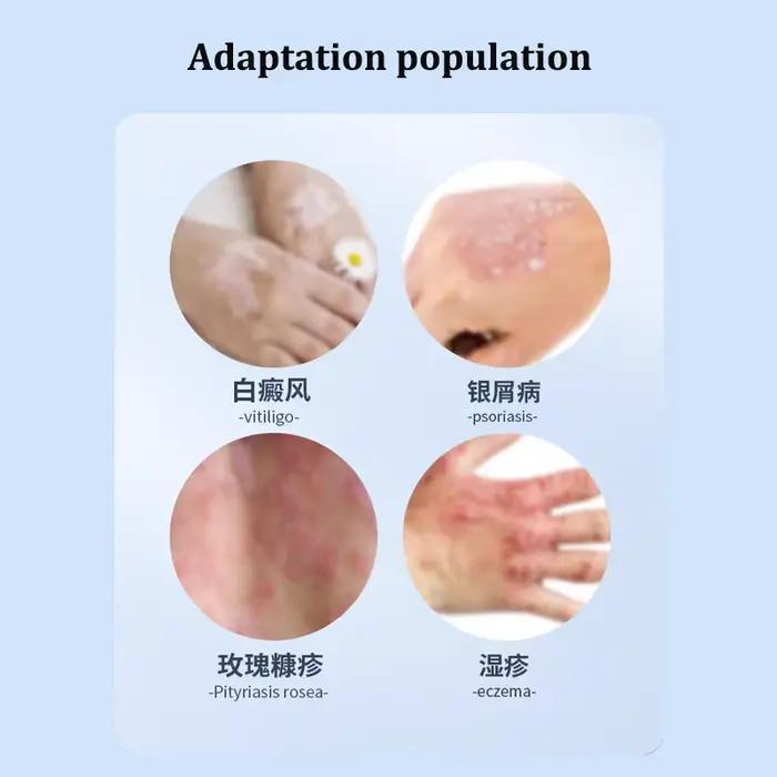 Lampe ultraviolette à bande étroite UVB 311NM, Instrument de photothérapie, traitement du Vitiligo, dispositif de thérapie du Psoriasis